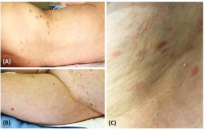 Case Report: Pityriasis Rosea-Like Eruption Following COVID-19 Vaccination